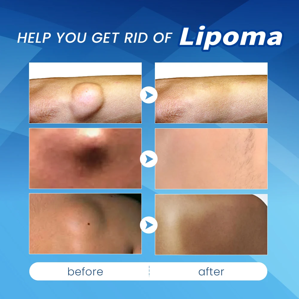 Пластырь Lipoma для снятия воспаления, 8-240 шт.