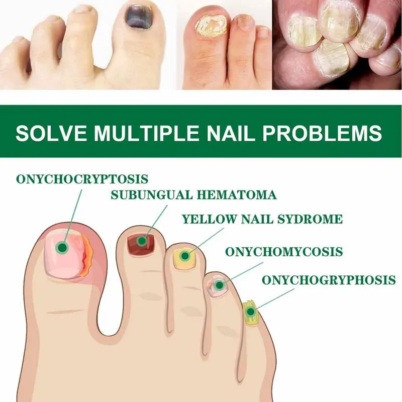 Essência do reparo do prego para o cuidado do toenail, solução para reparar o molde danificado, quebrado rachado, soro descolorido das unhas, essência natural, correção