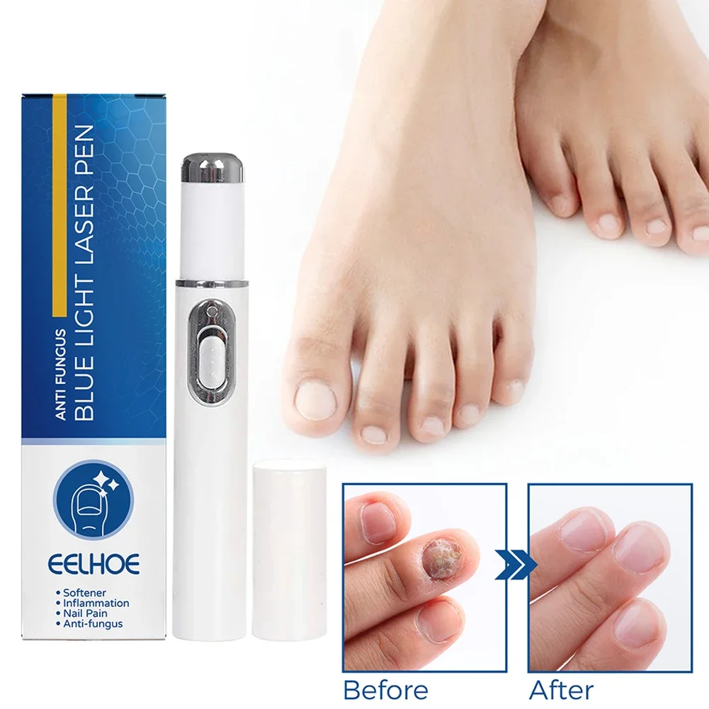 Hot Nail Fungal Pen Anti Fungus Blue Light Laser Pen Onychomycosis Painless Nail Repair Pen Nail Care Repair Serum Free Shipping