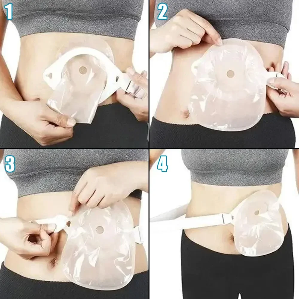 62/72/82/90mm Ostomy Surgery Bag Reinforcement Stoma Leak-Proof Stool Bag Stoma Belt Fixed Ring Buckle Style Accessories