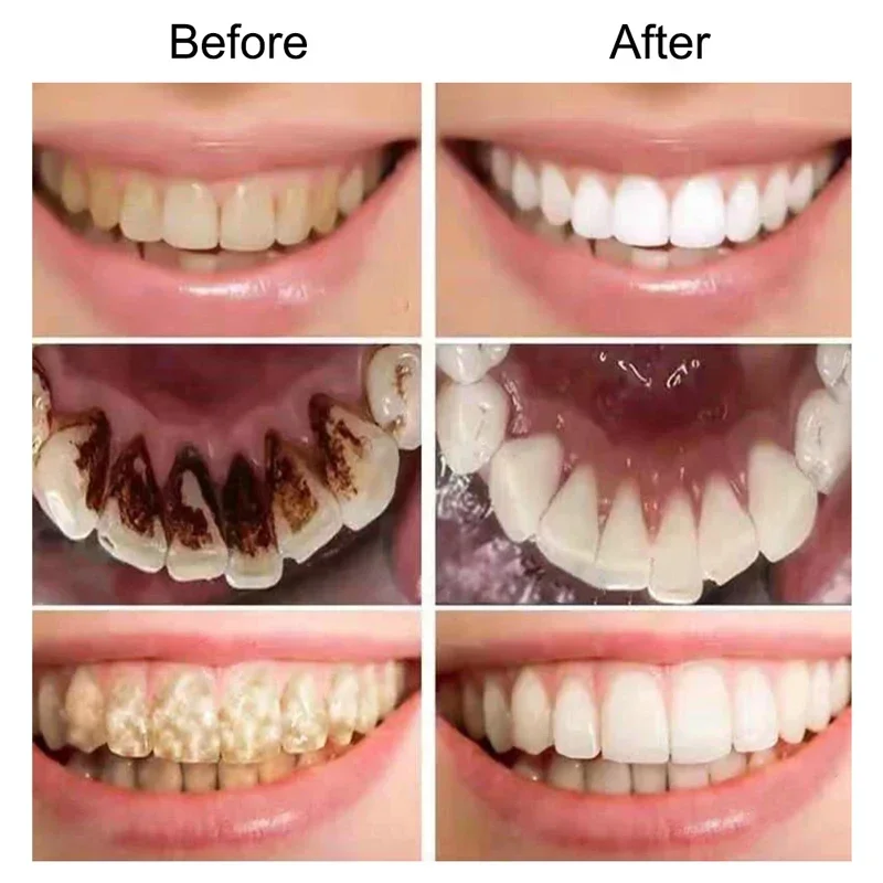 SUAI Teeth Whitening Essence Kit Dental Teeth Whitener Bleach Powder Oral Hygiene Dental Tools Remove Plaque Stains Fresh Breath