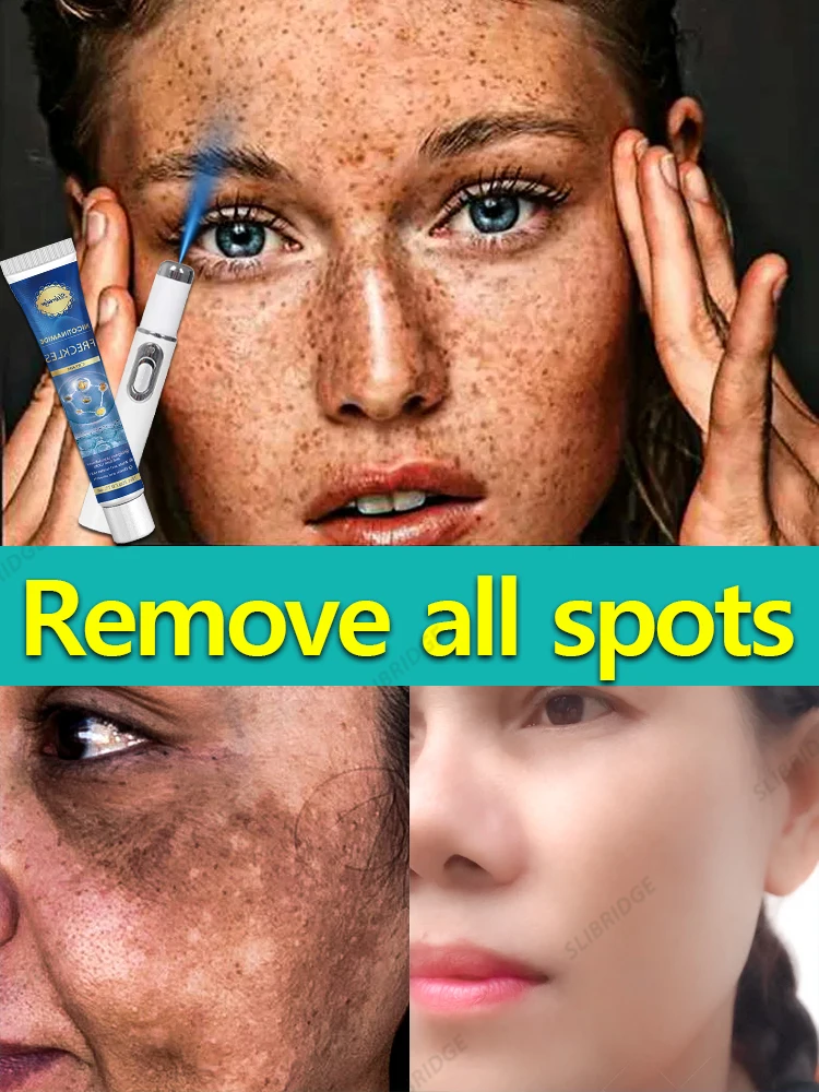 

Facial s-pots are gone Nano laser