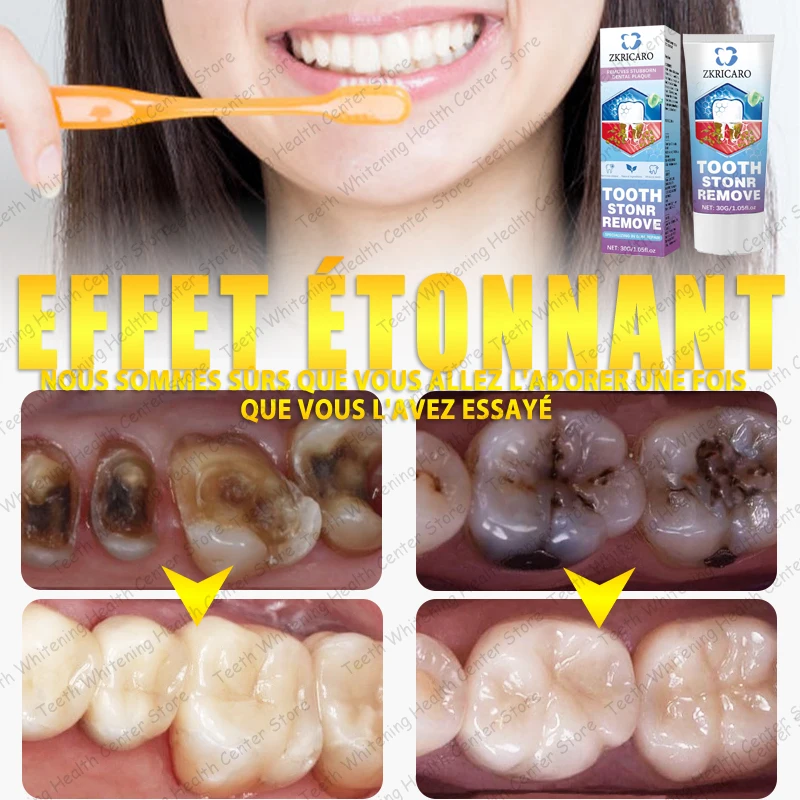 Vendita calda, necessità di molte persone, ripara la carie dei denti e mantiene i denti sani 2026