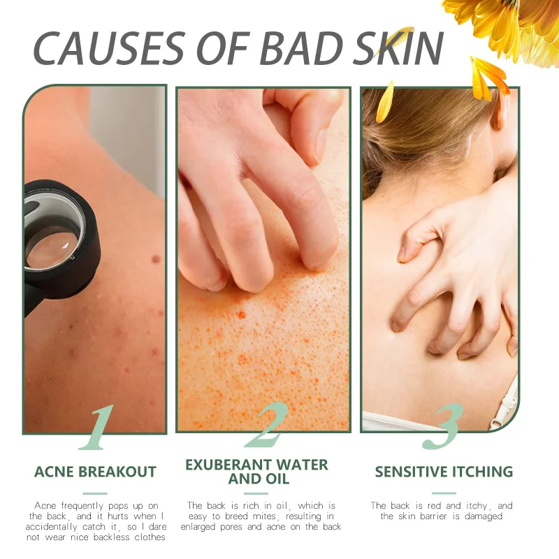 Schwefelsalbe, Aknebehandlung, entfernt Hühnerhaut, lindert verschiedene Hautprobleme, feuchtigkeitsspendende Aufhellungscreme, Hautpflegeprodukte