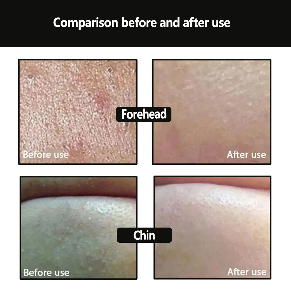 Máscara de removedor de cravo máscara facial preta tratamentos de acne descasque a máscara preta dos pontos pretos cuidados com a pele 3/5/6/10