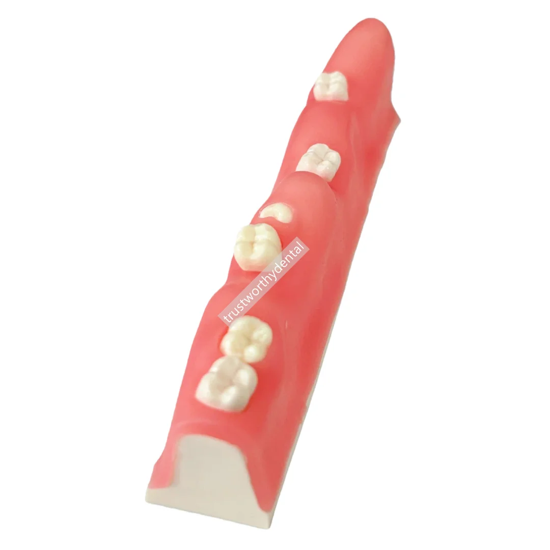 Impacted Tooth Extraction Model Block Used For Teeth Removal Incision Suturing Techniques Practice Model Training Extract Wisdom