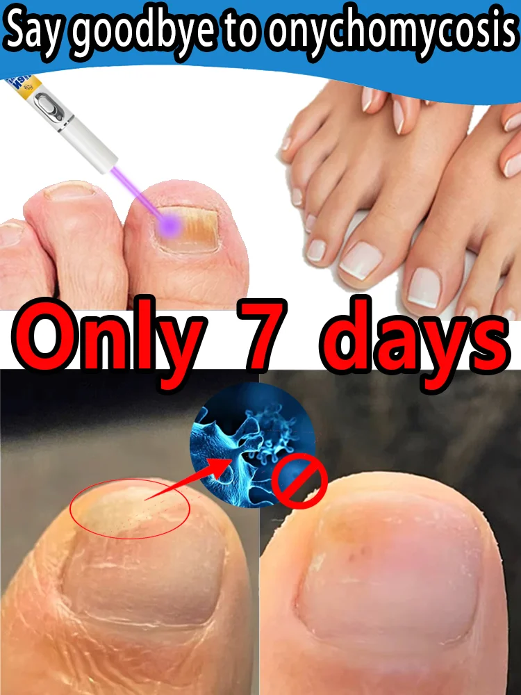 

Portable Laser Toenail Fungus Treatment Device - Home Use, No Drugs, Painless, Fast Results for Healthy Beautiful Nails
