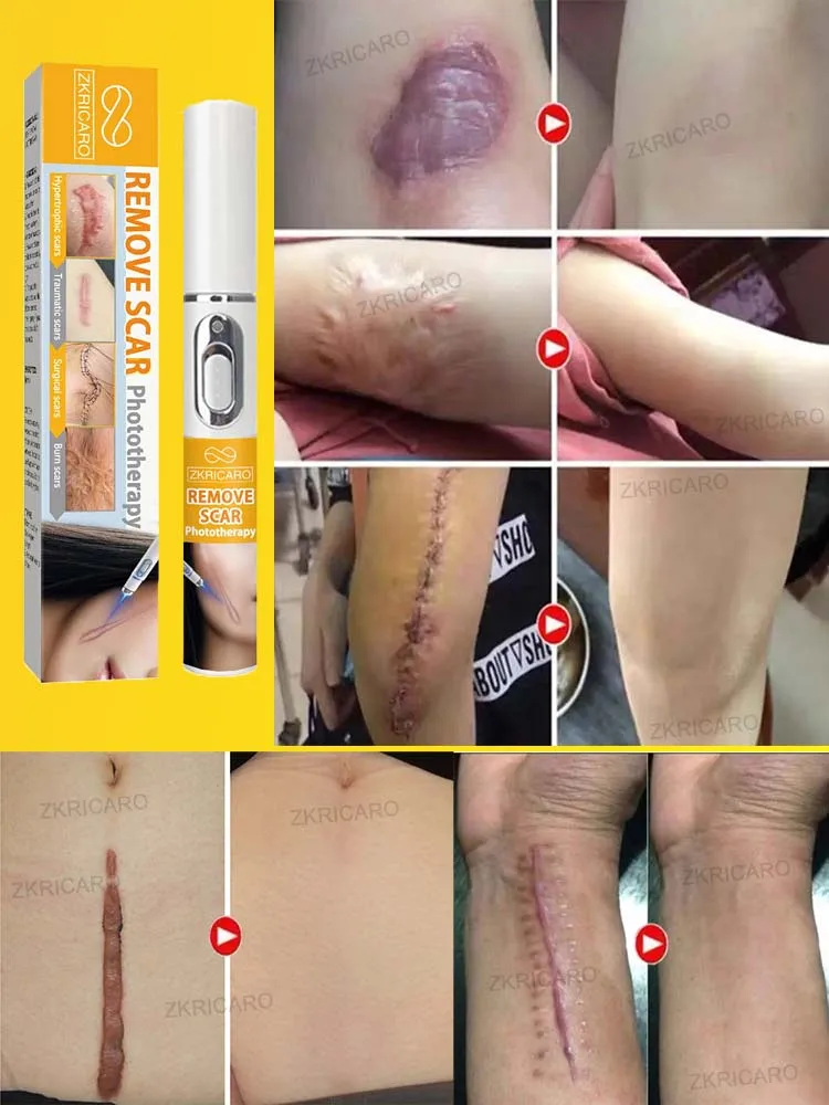 เลเซอร์พิเศษเพื่อความงามของรอยแผลเป็น |   ปากกาเลเซอร์แผลเป็น |   เหมาะสําหรับรอยแผลเป็นทุกชนิด