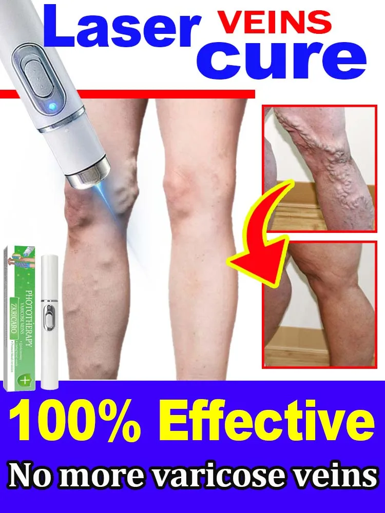 

Powerful laser therapy relieves pain and improves circulation in men and women for moderate varicose veins