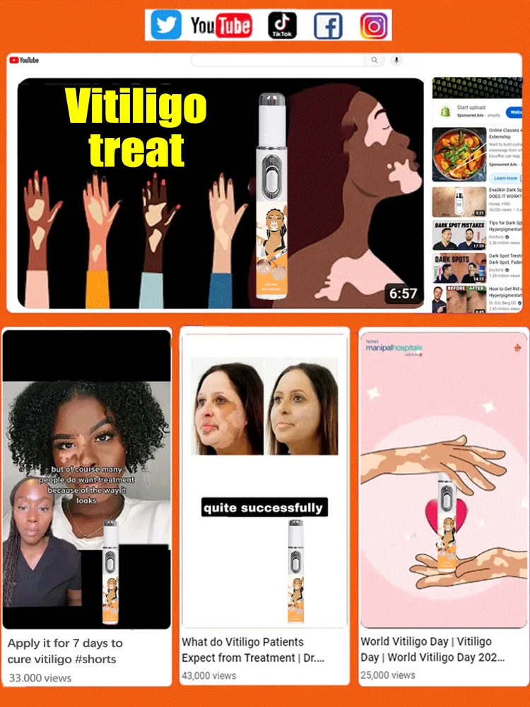 Pena cahaya biru mengatasi Vitiligo, Pena Perawatan Tubuh Terapi Laser