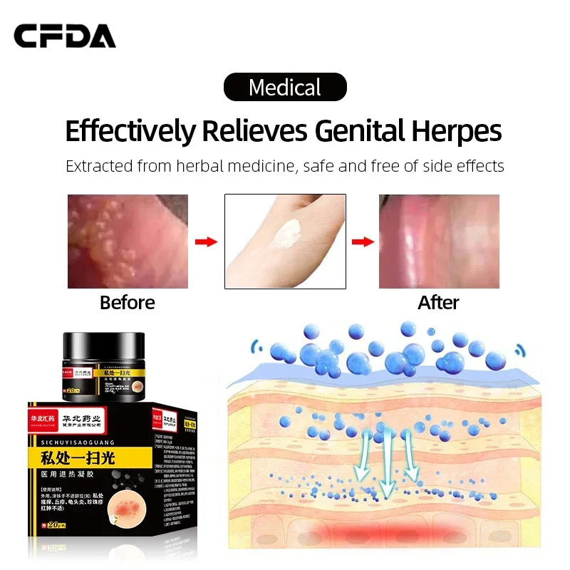 2Boxes Genital Herpes Removal Balanitis Candida Treatment Cream Mens Ointment Medicine Cure Pearly Papules Remover 20g