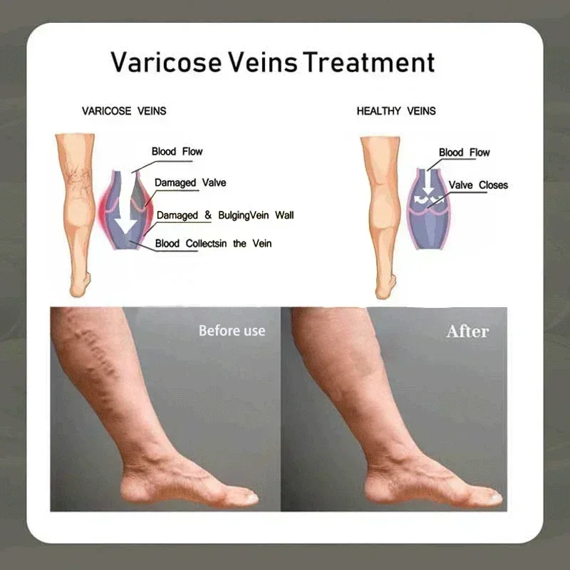 ใหม่เส้นเลือดขอดซ่อม Tongmai ที่มีประสิทธิภาพบรรเทาขา Bulge Pain Treatment Vasculitis Phlebitis ลบหลอดเลือดดํา 77