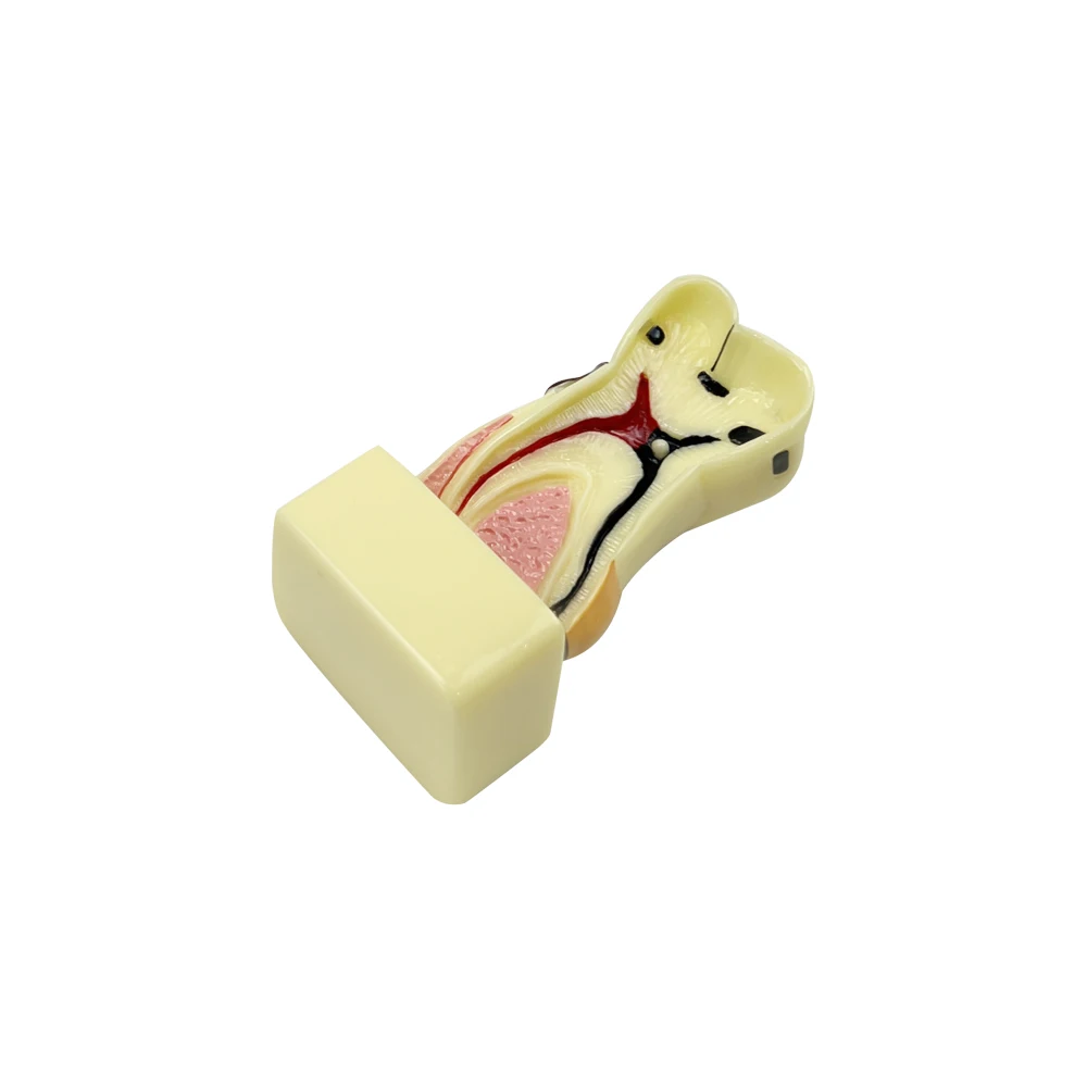 4/6/8 Times Dental Caries Model Disease Teeth Dental Model for Dental Demonstration Model Dentist Teaching Dental Oral Research