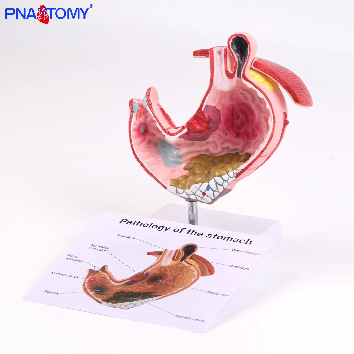 

Pathological Human Stomach Anatomical Model Medical Teaching Tool for Gastric Disease Demonstration Lesion Simulation with D