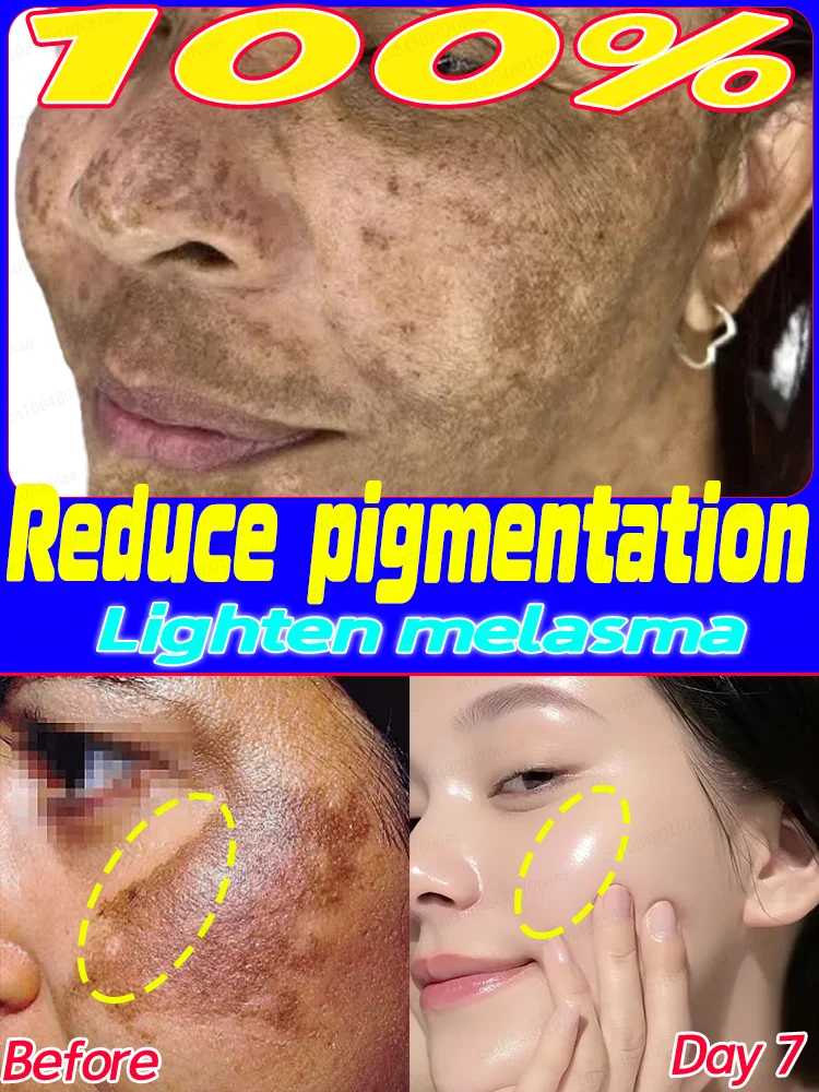 

Sᴘᴏᴛ ʀᴇᴍᴏᴠᴀʟ Improve dark spots, melasma, dullness, and acne scars. Niacinamide lightens melanin deposits.