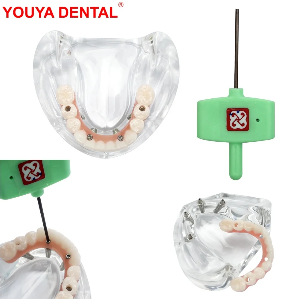 

4 Implants Mandible Implant Model For Education Studying Lower Jaw Removable Dental Overdenture Teeth Model With Screws Typodont