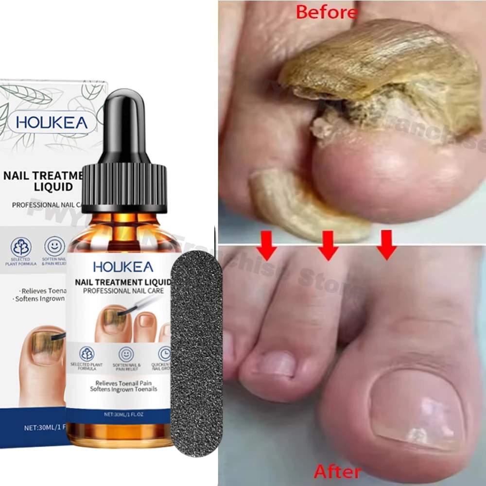 Nail Fungus Treatment Serum Treatment Toe Nails Fungal Removal Essential Oil Anti Infection Paronychia Onychomycosis Health Care