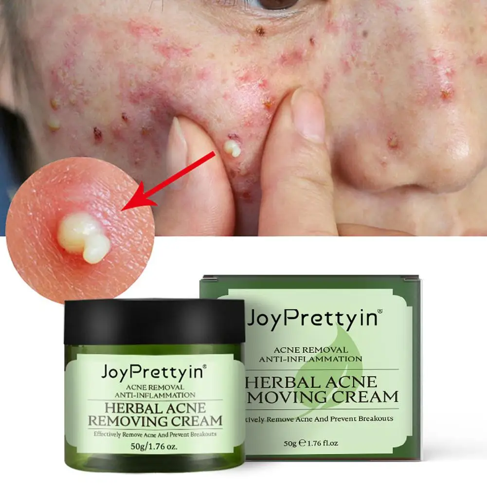 شجرة الشاي العشبية كريم حب الشباب السيطرة على النفط شجرة الشاي مصل المسام مستحضرات التجميل الكورية إزالة بثرة الرعاية إصلاح الجلد حب الشباب الوجه Clea A2I1