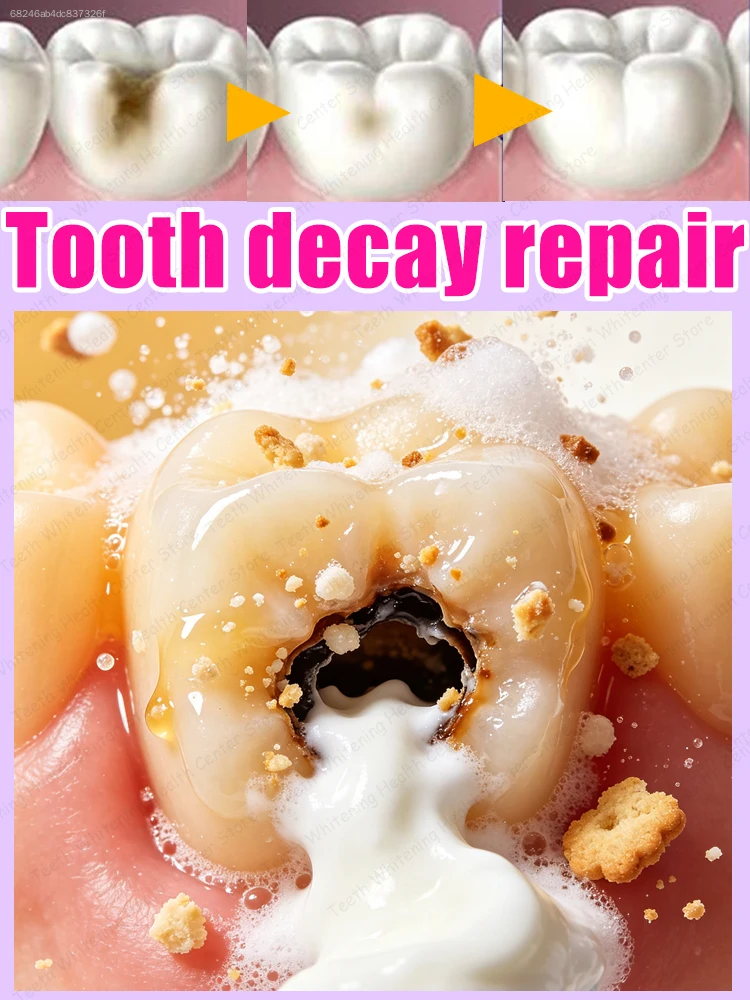 Лечение кариеса A toothpaste that can effectively clean teeth