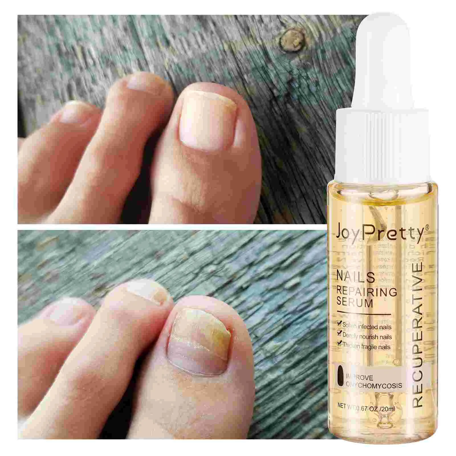 Solution liquide de traitement d'onychomycose pour la réparation des ongles, kit de soin des pieds, gel, sérum réparateur, phytothérapie chinoise, N64