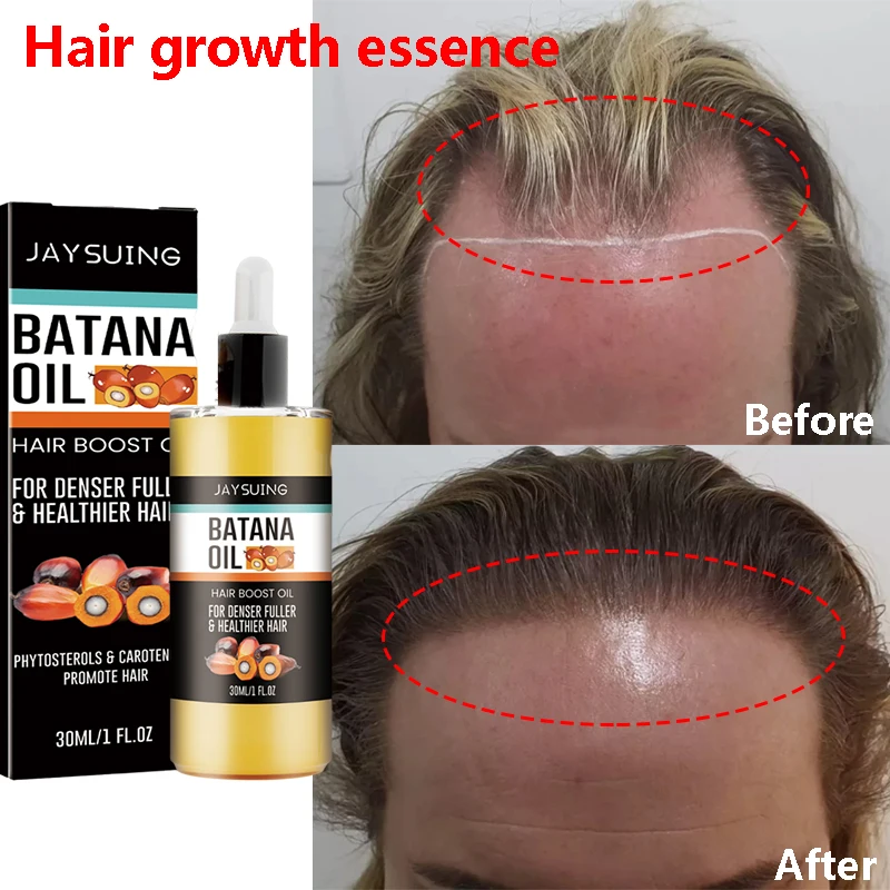 Fast Hair Growth Set Batana Oil Traction Alopecia Hair Mask Anti Break Loss Hair Growth Oil Baldness Treatment Hair Health Care - Image 5