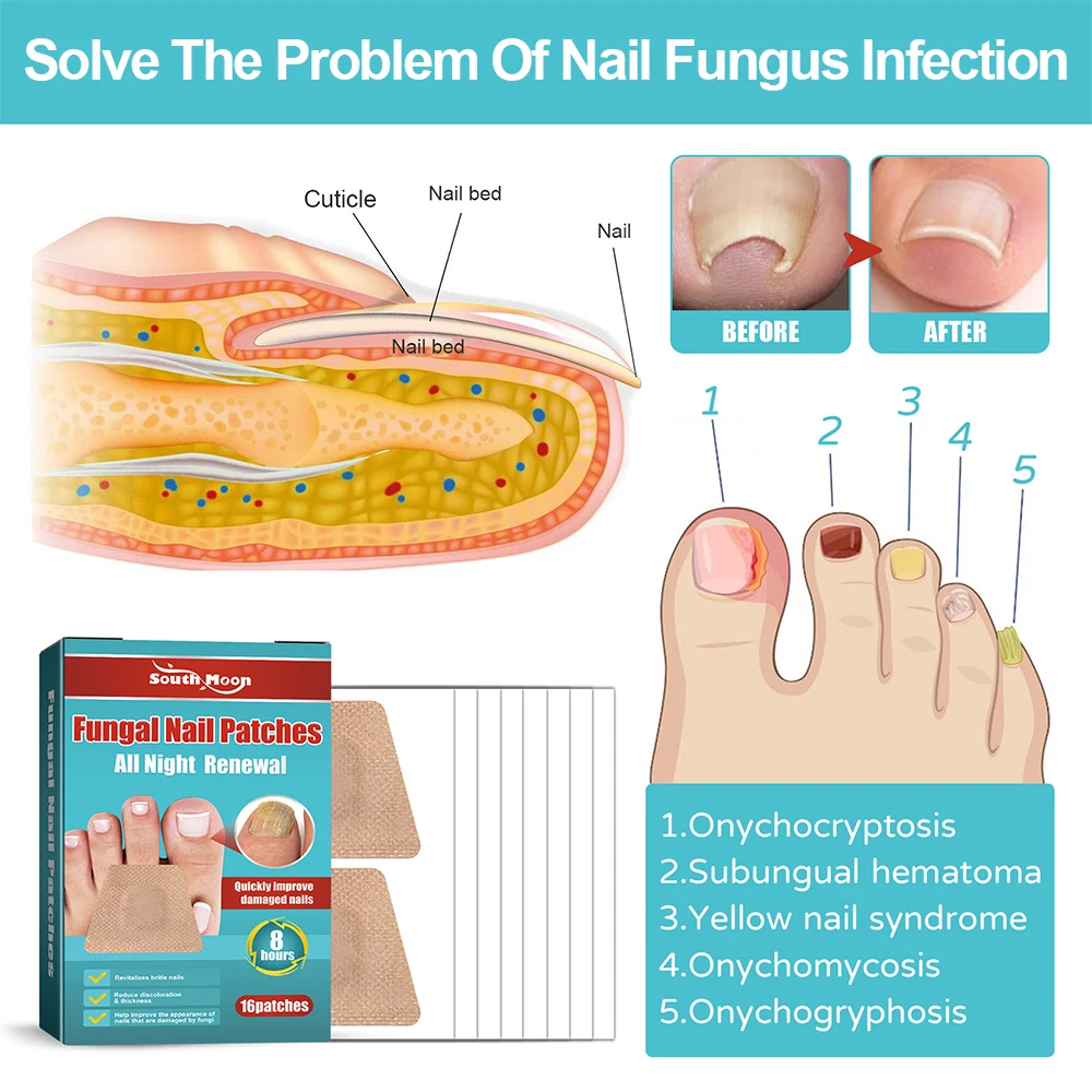 Anti Infection Nail Patch, Remoção de onicomicose, Grey Nail Repair, Remover fungo, Ingrown Toenail Care, Etiqueta do tratamento Paronychia