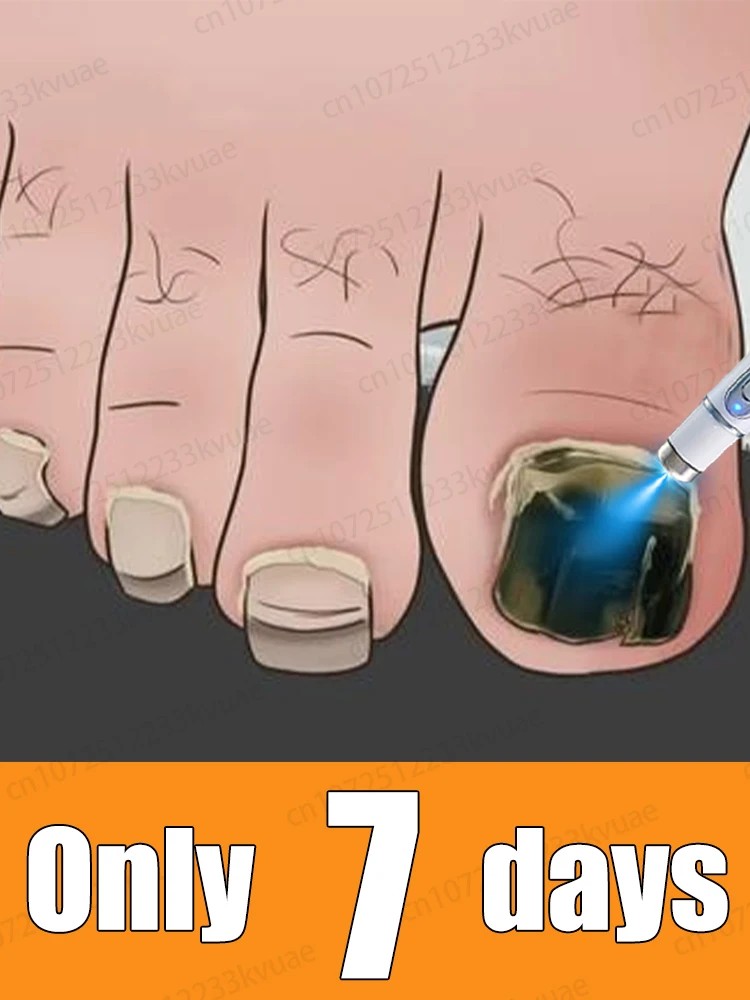 

Восстановите свой гвоздь в обычный. Скажи прощайте на онихомикоз.