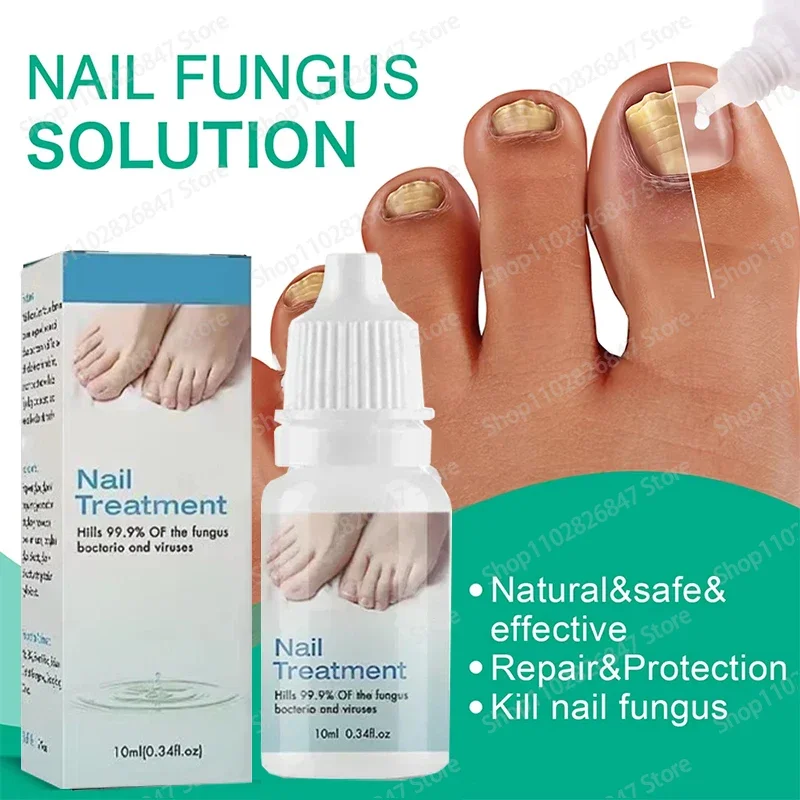 Anti-Infection Cream Fungus Nail Removal Fungus Foot Repair Serum