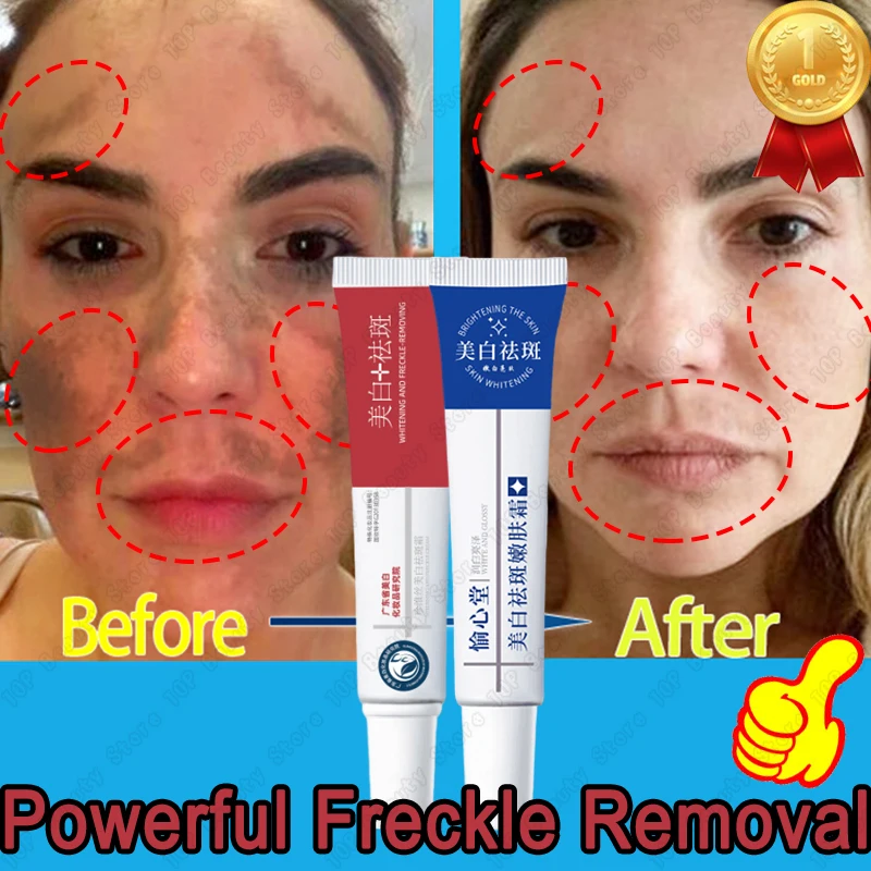 Effective Whitening Freckle Cream Remove Melasma Dark Spots Fade Pigmentation Moisturize Smooth Brighten Face Skin Care Products