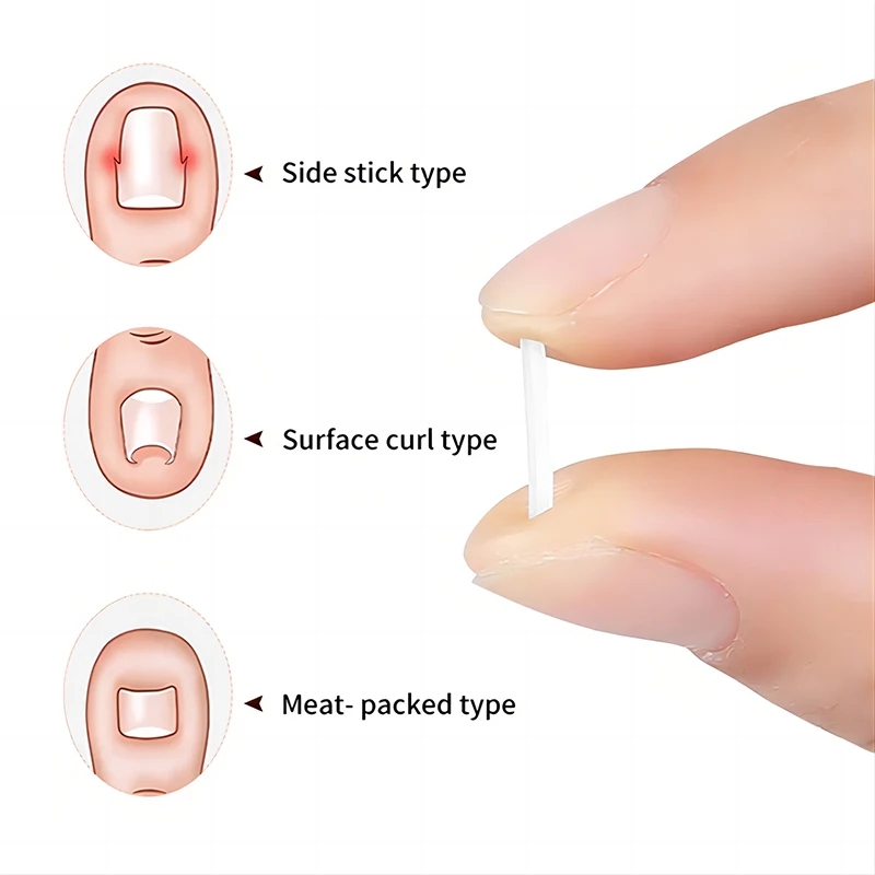 Ingrown Toenail Correction Tool Nail Filling Pad Ingrown Toe Nail Treatment Elastic Patch Straightening Clip Brace Pedicure Tool