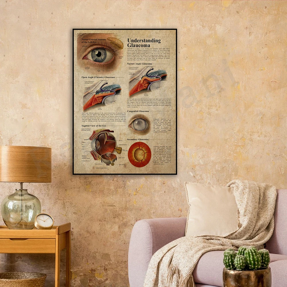 Understanding Glaucoma Poster Glaucoma Knowledge Poster Glaucoma Doctor Gift Ophthalmologist Gift