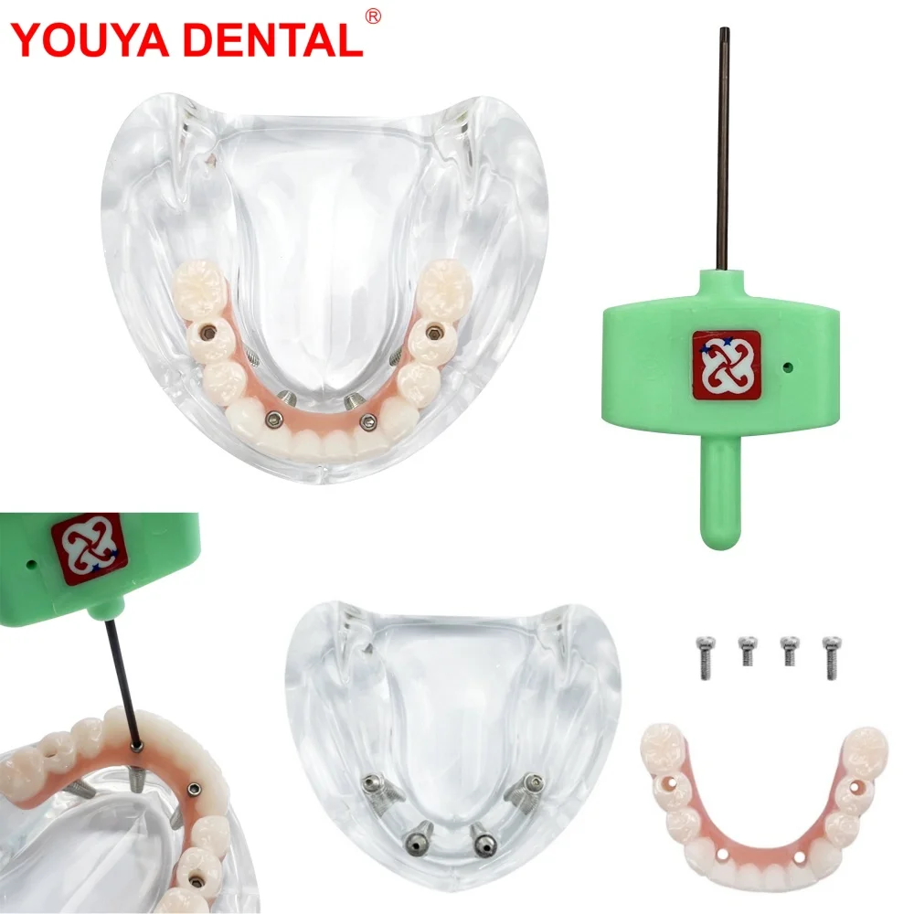 Lower Jaw Implant Model For Education Teaching Mandible Dental Overdenture Teeth Model With 4 Implants Removable Screws Typodont