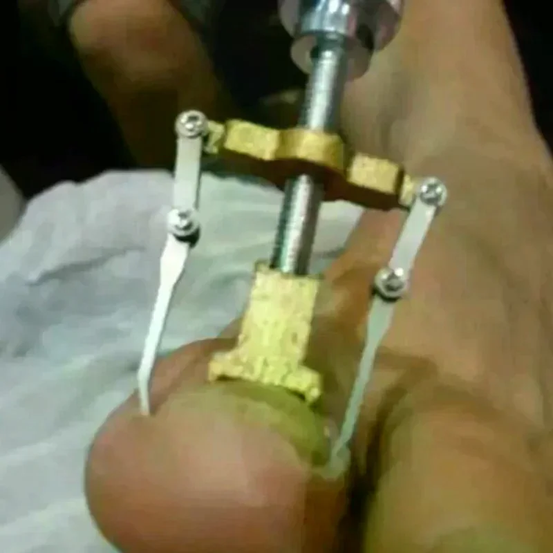 Professional Ingrown Toe Nail Correction Tool For Pedicure Foot Care