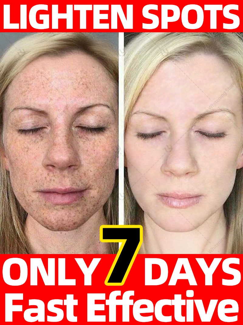 

Say Goodbye to Dark spot