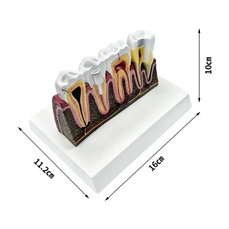أمراض الأسنان هيكل تشريحي نموذج طبي لتدريس دراسة علاج قناة الجذر مظاهرة أسنان طبيب الأسنان #6
