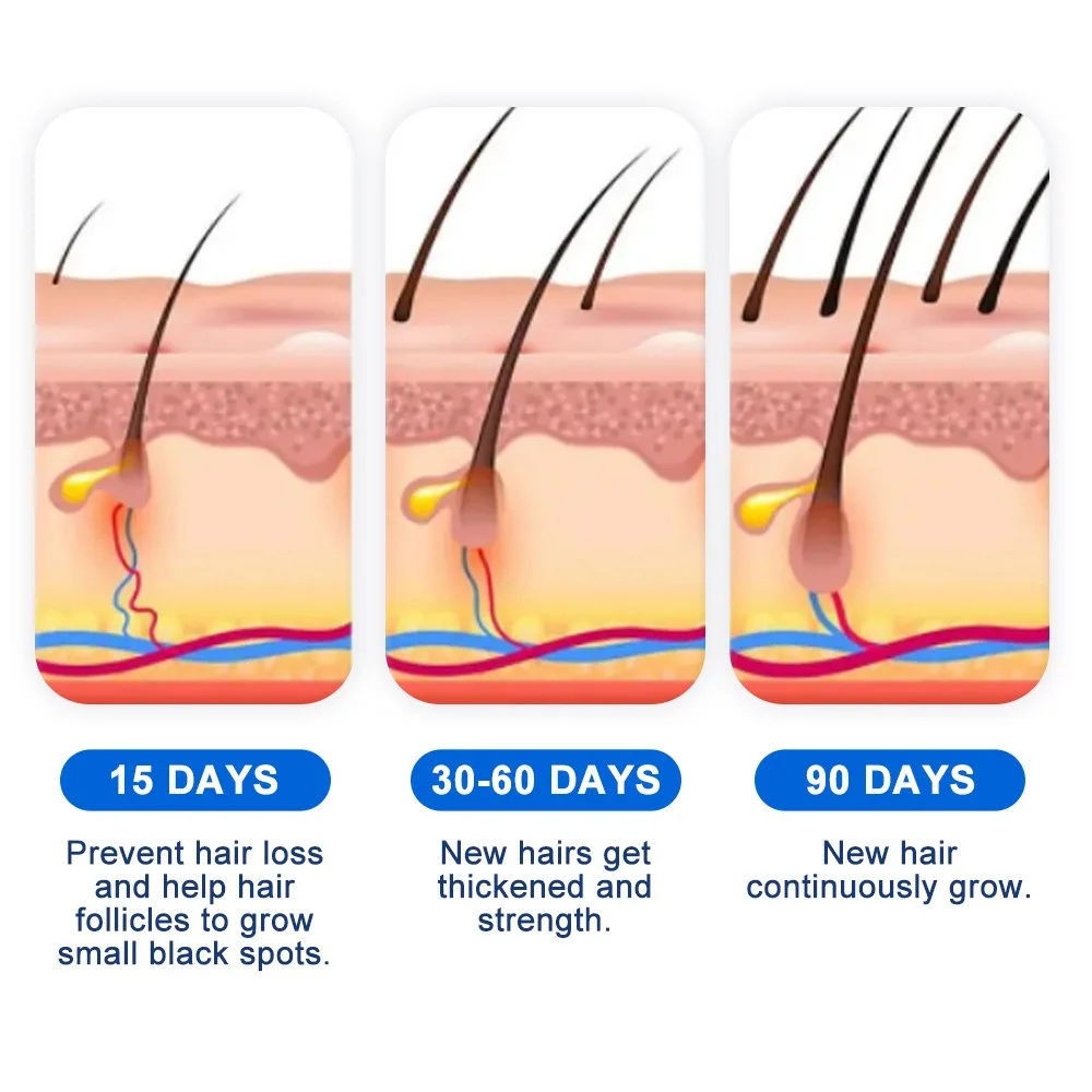 Alopecia Spray de croissance d - Hair Care Spray avis et prix
