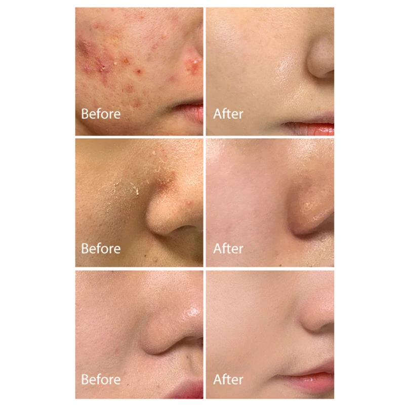 كريم إزالة حب الشباب بحمض الساليسيليك كريم إزالة حب الشباب يهدئ ويخفف علامات حب الشباب ويصلح كريم العناية بالبشرة بلطف #4