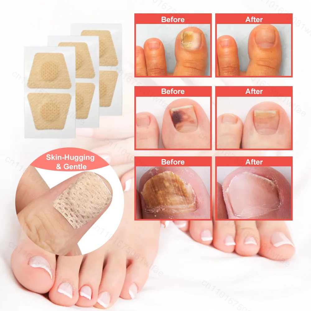 Parches de reparación de uñas, pegatinas transpirables para tratamiento de uñas de paroniquia, Corrector de uñas encarnadas adhesivo impermeable, parche de hongo
