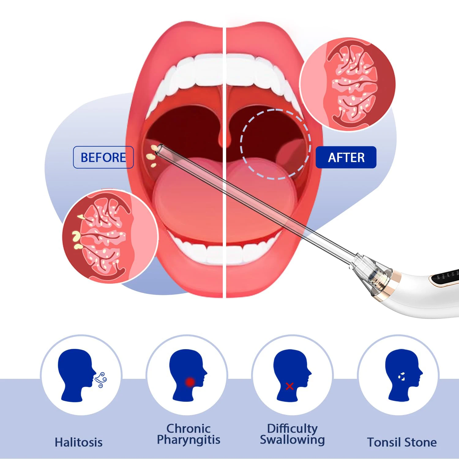 Tonsil Stone Remover Kit Electronic Vacuum Oral Care Mouth Cleaner with 5 Suction Modes 10 in 1 Instant Suction Tools