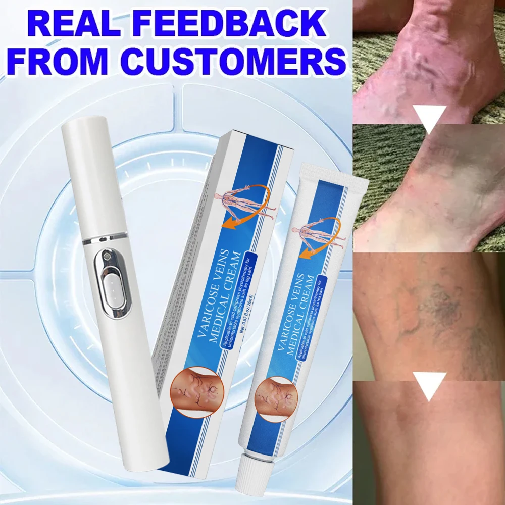 Laser Therapy Varicose Veins Relieve Blue Light Pen Effective Varicose Veins Relief Cream Phlebitis Spider Pain Treatment