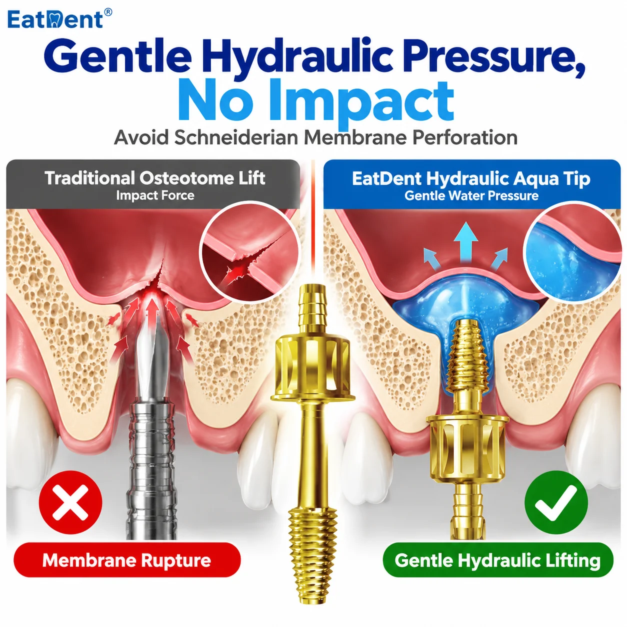 Dental Hydraulic Lifter Tip Water Pipe Kit Leak-Proof Seal Maxillary Sinus Lift Membrane Water Rising Tool Crestal Guide Drill