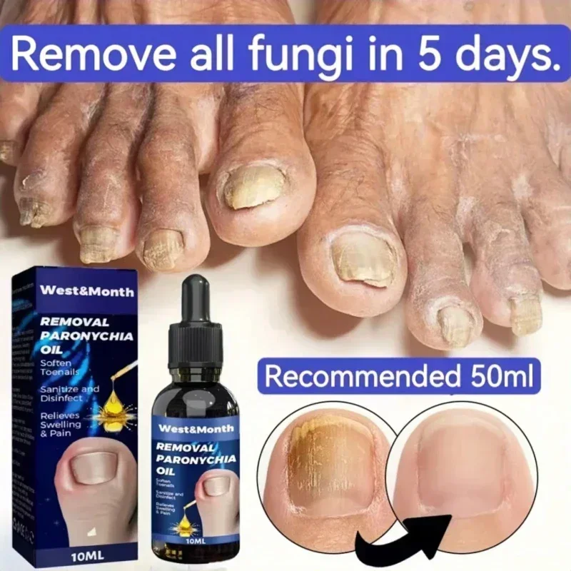 Toenailcare Removal Paronychia Oil Ingrown Toenail Treatment Nail Renewal Liquid Bad Nail Thicken Nail Soft Nail Repair Solution