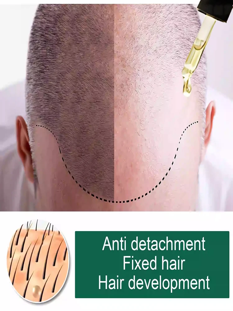 

Lᴏsɪɴɢ ʜᴀɪʀ Tʜɪs ɴᴇᴡ ʜᴀɪʀ ɢʀᴏᴡᴛʜ sᴇʀᴜᴍ ᴄᴀɴ ᴍᴀᴋᴇ ʏᴏᴜʀ ʜᴀɪʀ ᴛʜɪᴄᴋᴇʀ