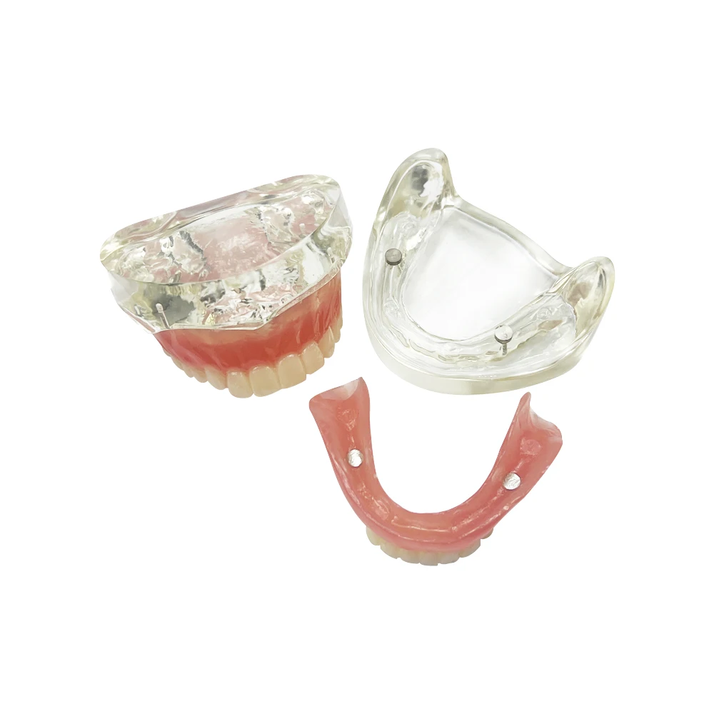 1 Set Dental Implant Removable Adsorption Upper Lower Jaw Tooth Model With 2 Implants Research Overdenture Dentist Teaching Demo