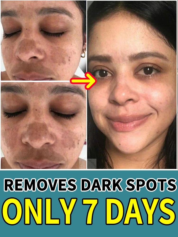 

Sensitive Skin Spot Treatment - Gently Fades Sun Spots with Hydration