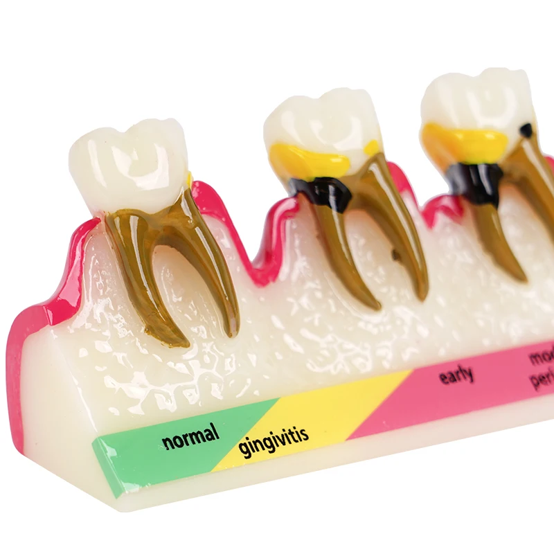 Model zębów dentystycznych Choroba przyzębia Model demonstracyjny 5-stopniowy wyświetlacz próchnicy dla dentysty, nauki, nauczania, edukacji