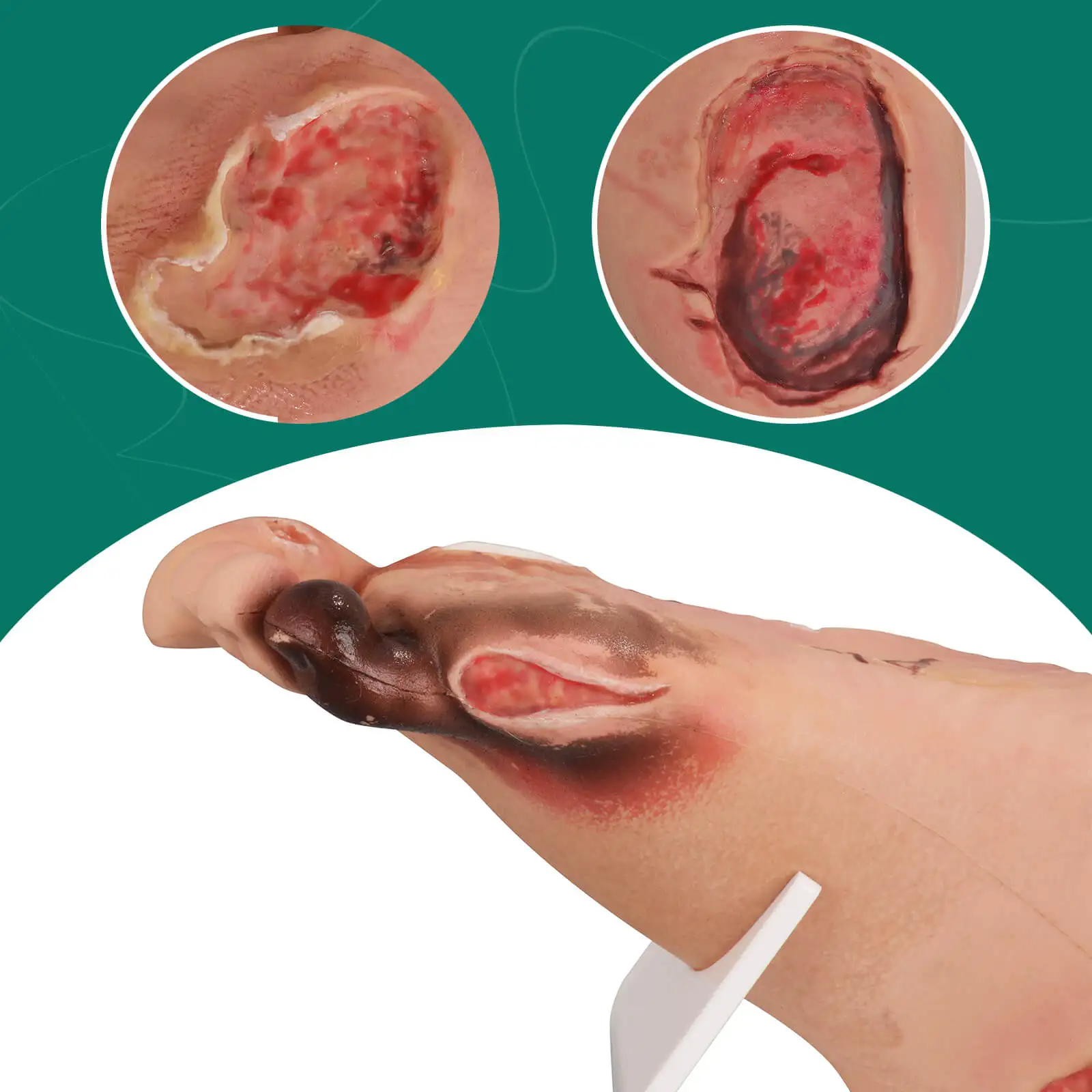 Ultrassist Diabetic Foot Ulcer Model Set Mild & Severe Stages Anatomical Accuracy Pathology Study Tool for Medical Training