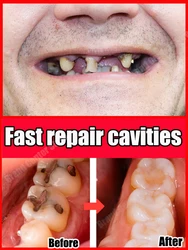 tooth decay repair cavities protect teeth