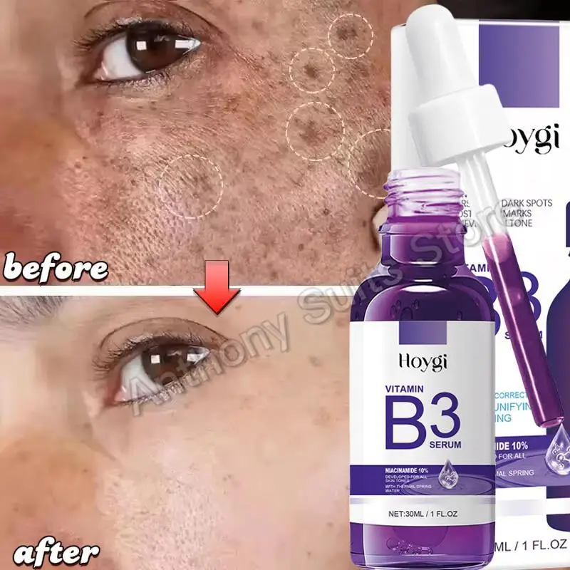 

Vitamin B3 Serum Fade Dark Spot Chloasma Lighten Melanin Pigmentation Smooth Pores Rejuvenation Brightening Moisturizing Essence
