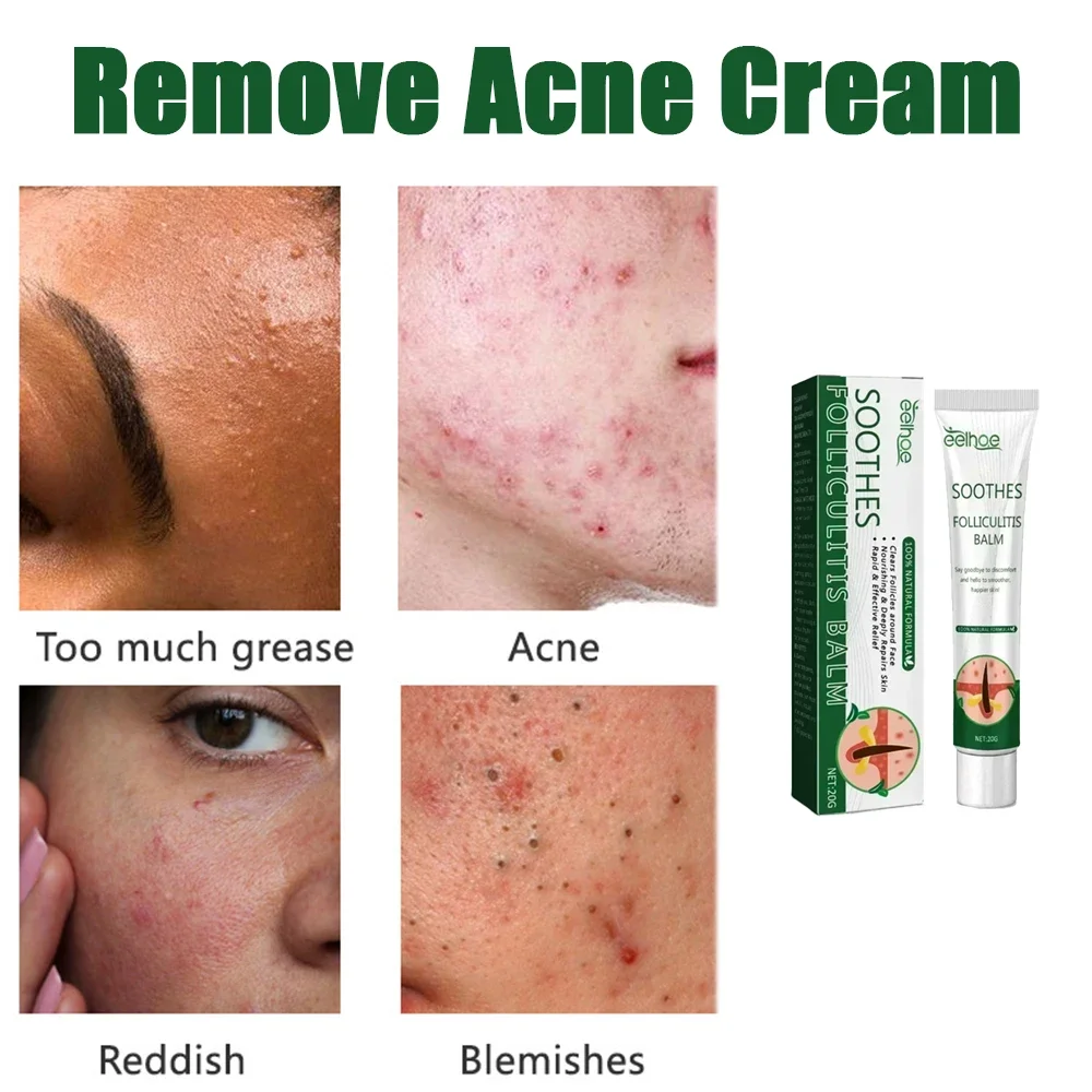 

Acne Remover Serum with Pimple Remover, Tighten Pores, Oil Balancing Skin Care Formula